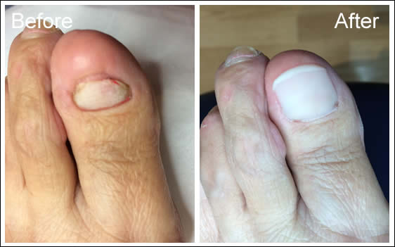 Chiltern Foot Clinic - Toenail Reconstruction