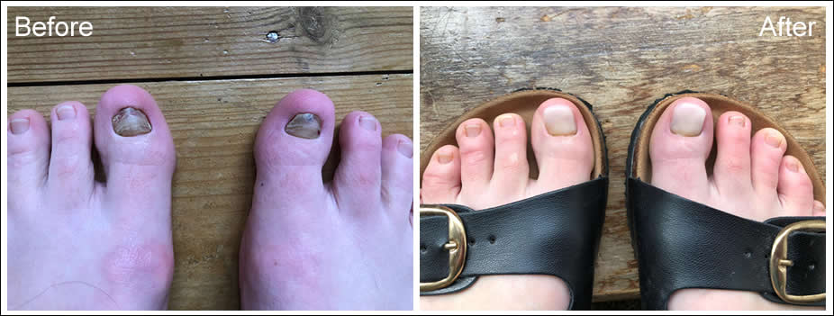 Chiltern Foot Clinic - Toenail Reconstruction